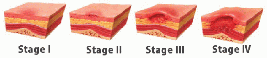 Pressure Sore Stages